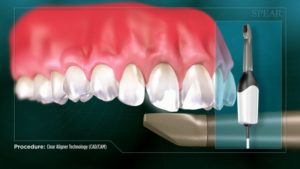 Clear Aligner Technology (CAD/CAM)