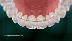 Orthodontic Retainers- Fixed