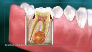 Endodontic Abscess