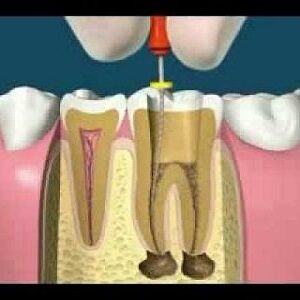 Endodontics Root Canal Therapy