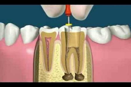 Endodontics Root Canal Therapy