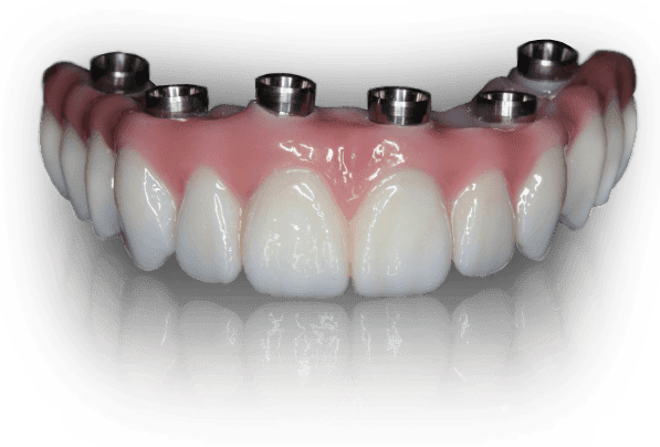 Prettau Dental Implants