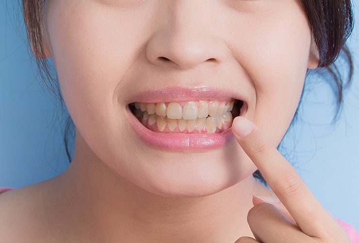 Причини, чому наші зубі втрачають білий колір 