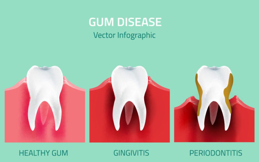 4 Signs You Have Gum Disease and What to Do About It Art of Smiles
